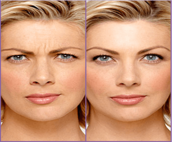 Can Physical Activity Affect Botox Lifespan?